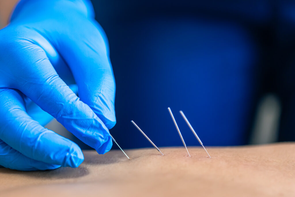 Acupuncture